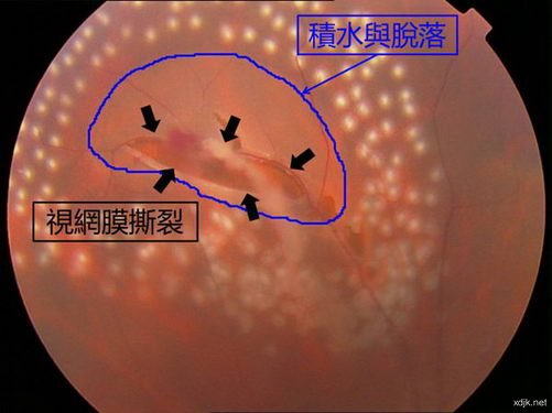 ?，斞劭漆t(yī)院：視網(wǎng)膜脫落更愛找上這幾類人
