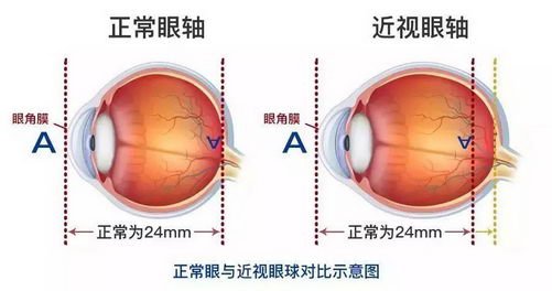 希瑪眼科醫(yī)院：視網(wǎng)膜脫落更愛找上這幾類人