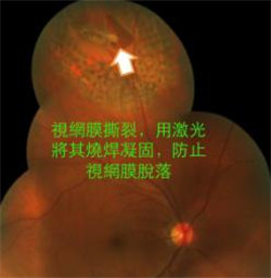 飛蚊癥,珠海治療飛蚊癥,珠海?，斞劭漆t(yī)院