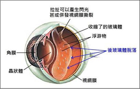 飛蚊癥,珠海治療飛蚊癥,珠海?，斞劭漆t(yī)院