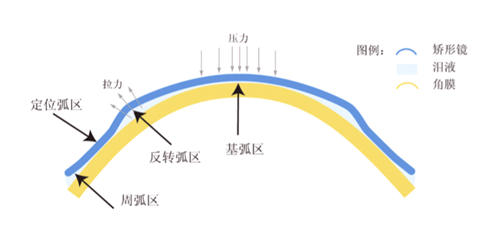 OK鏡對眼睛傷害大嗎？