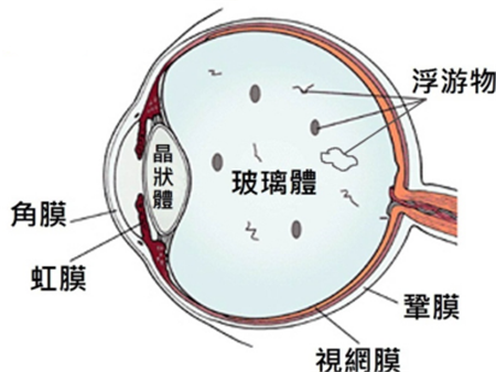 飛蚊癥是如何產(chǎn)生的