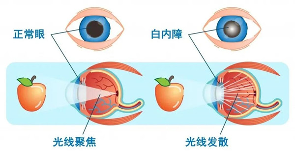 白內(nèi)障手術(shù),珠海白內(nèi)障醫(yī)院,珠海白內(nèi)障治療醫(yī)院