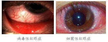 眼睛紅、痛是什么原因造成？