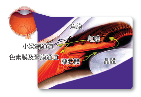 青光眼,青光眼治療,慢性青光眼,青光眼治療