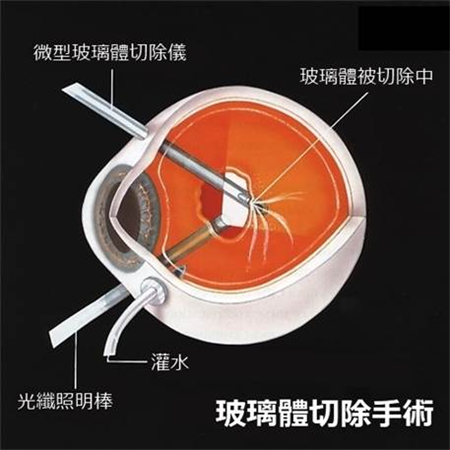視網(wǎng)膜,視網(wǎng)膜脫離,高度近視,視網(wǎng)膜脫離治療,玻璃體切除手術(shù)